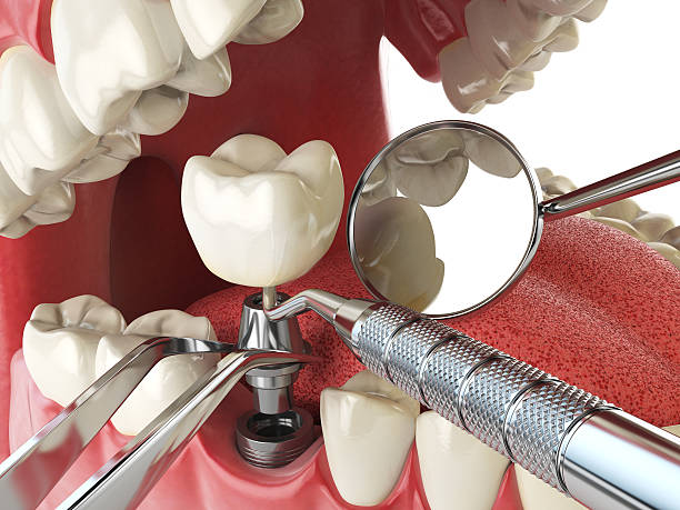 Best Emergency Denture Repair in Charleston, WV